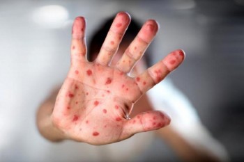 Более 20 человек заразились краснухой в Мангистауской области